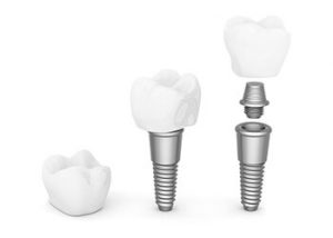 dental-implants-price-comparison-sydney