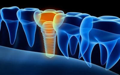 A Comprehensive dental implants price comparison
