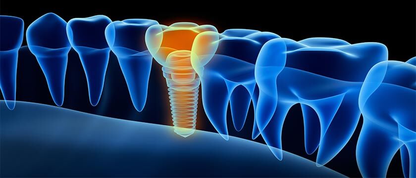 sydney-dental-implants-price-comparison
