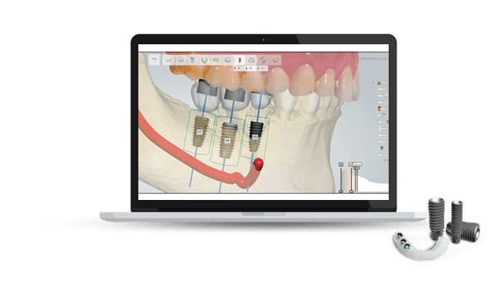 digital dental implants in sydney