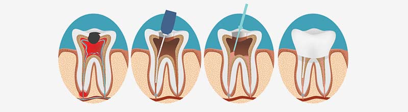 root canal in sydney
