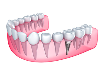 how-long-do-dental-implants-last-sydney