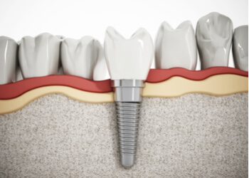 dental-implants-india-sydney